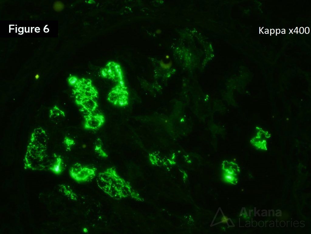 Kappa stain, renal imaging on biopsy