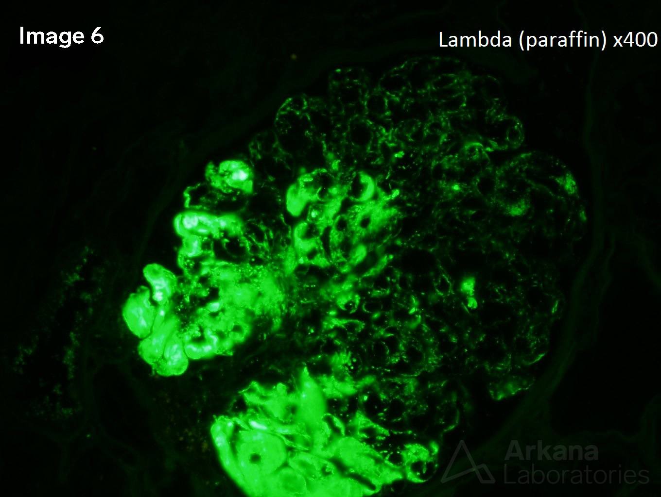 Type 1 Cryoglobulinemic Glomerulonephritis