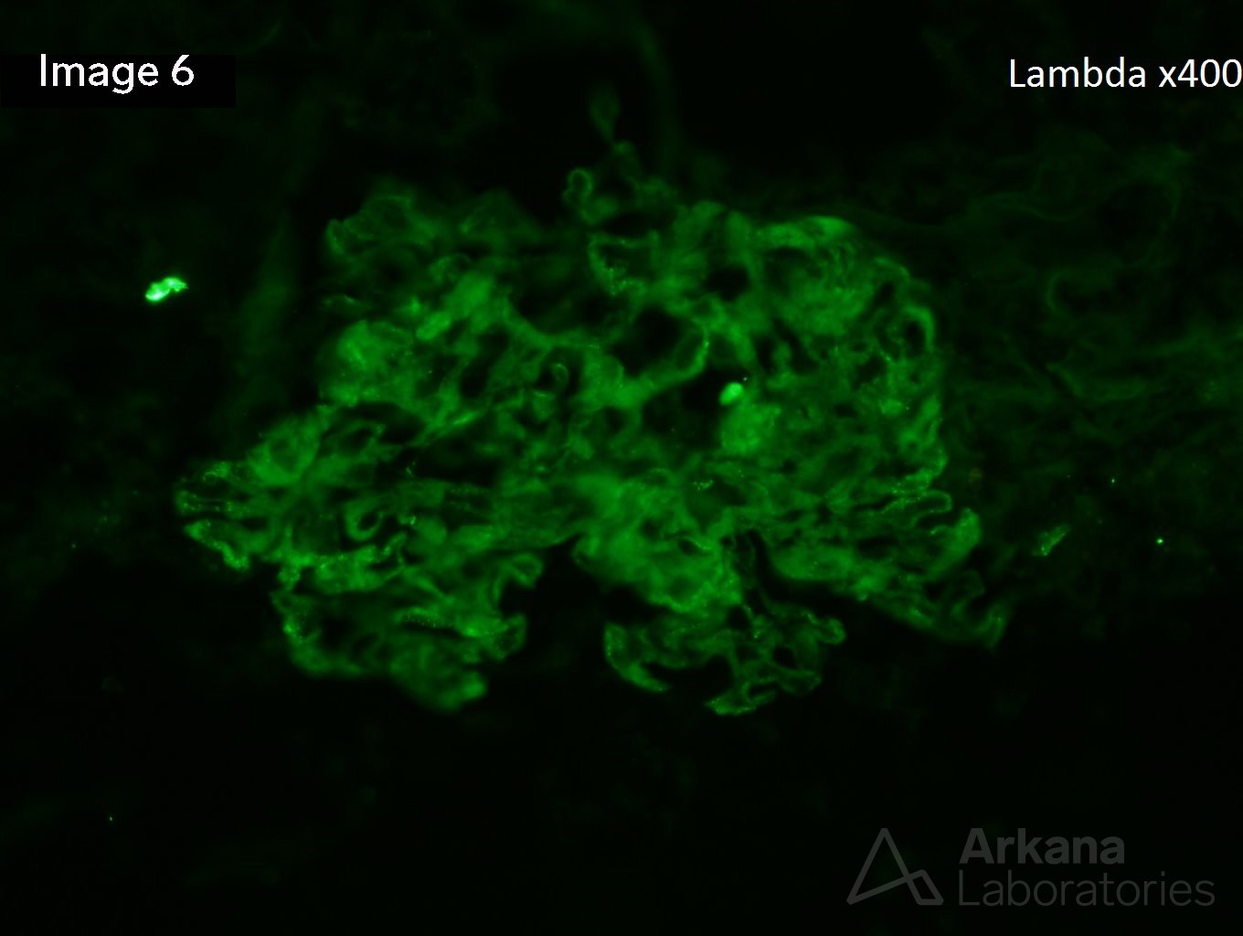 Membranous Nephropathy