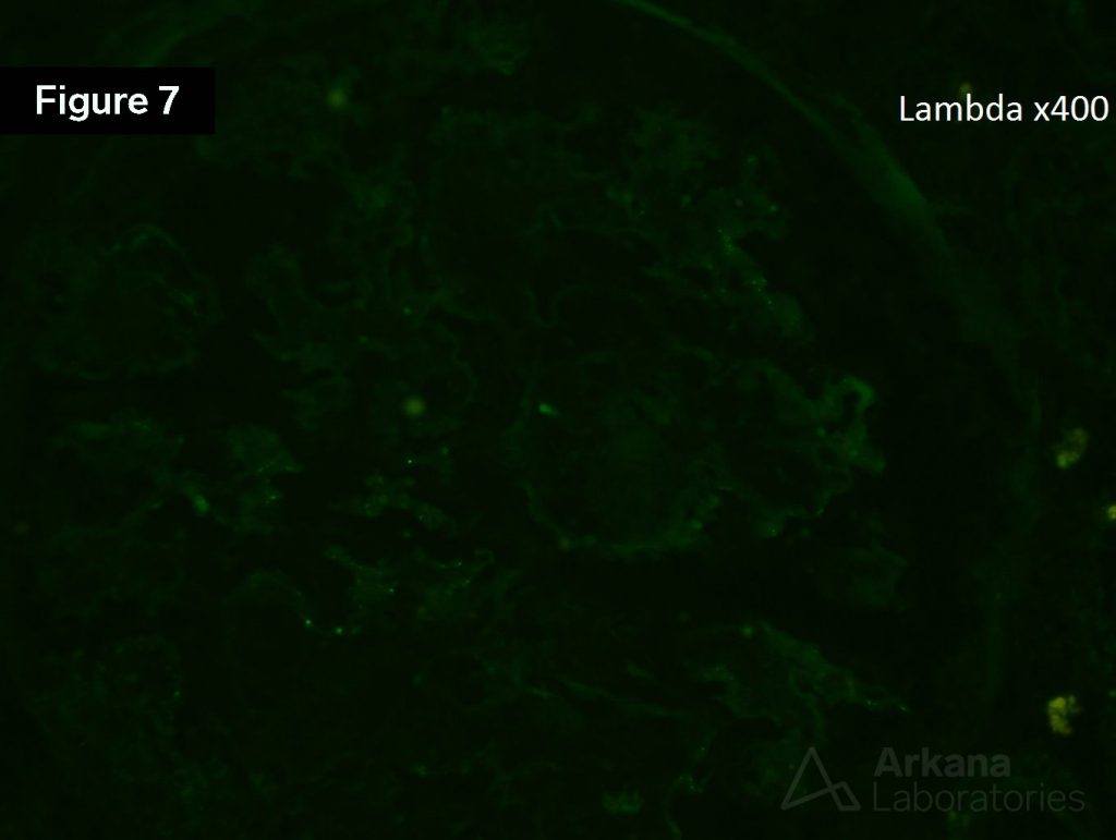 Lambda stain, Waldenström's Macroglobulinemia