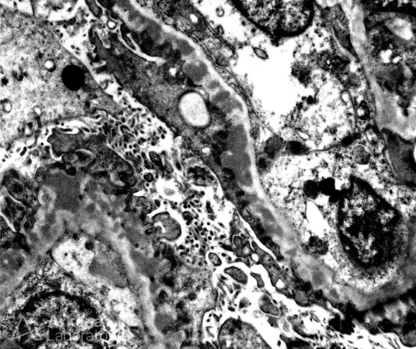 Membranous Lupus Nephritis