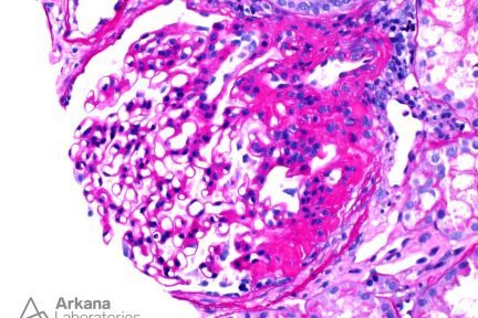 Obesity-Related Glomerulopathy