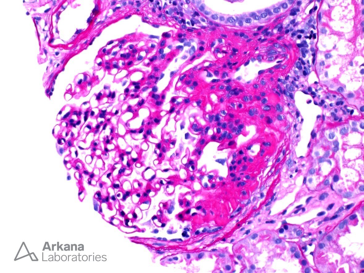 Obesity-Related Glomerulopathy