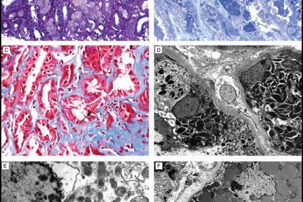 Light Chain Proximal Tubulopathy