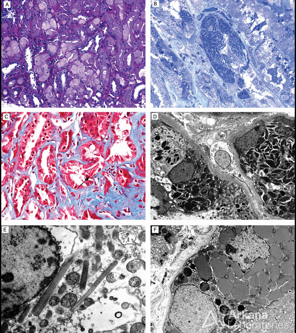 Light Chain Proximal Tubulopathy