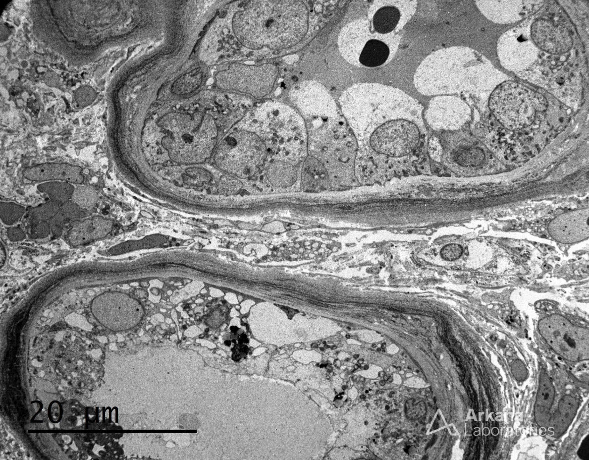 electron photomicrographs showing light chain deposition disease