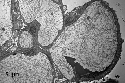 Lipoprotein Glomerulopathy