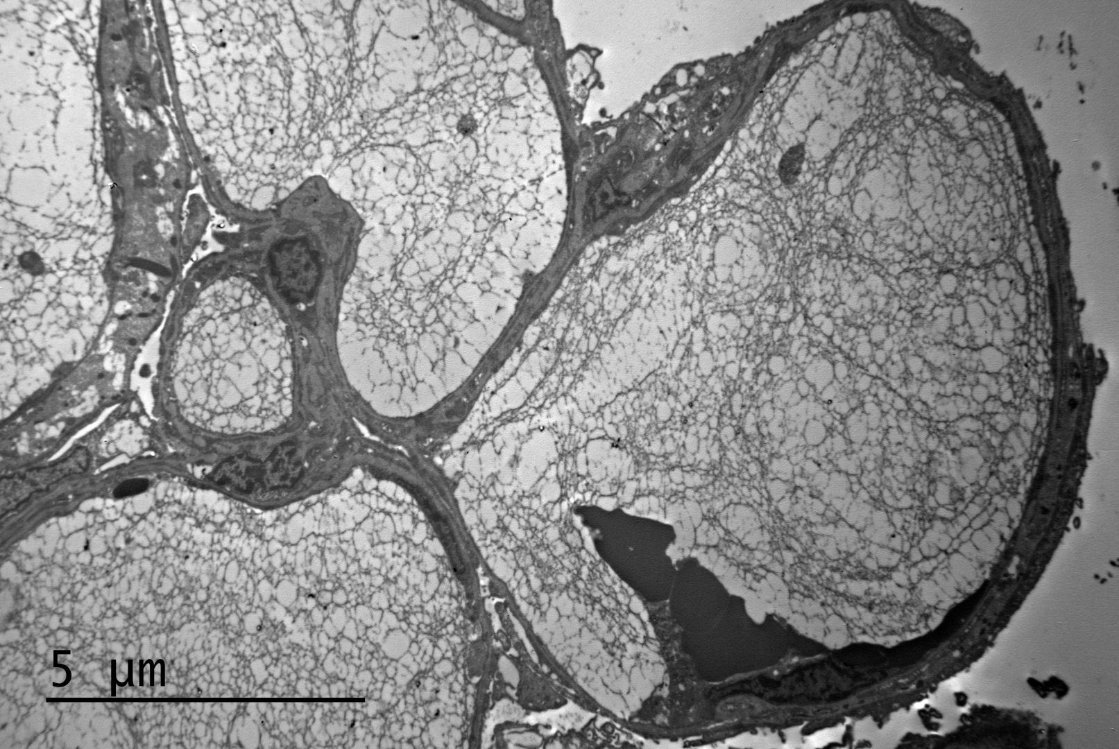 Lipoprotein Glomerulopathy