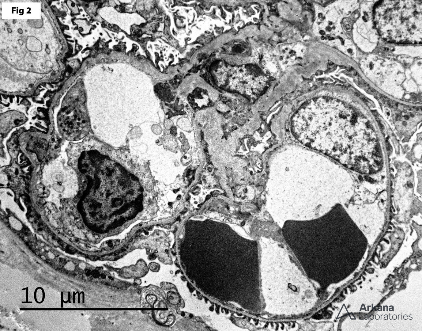 uniform thinning of the glomerular basement membranes by electron microscopy