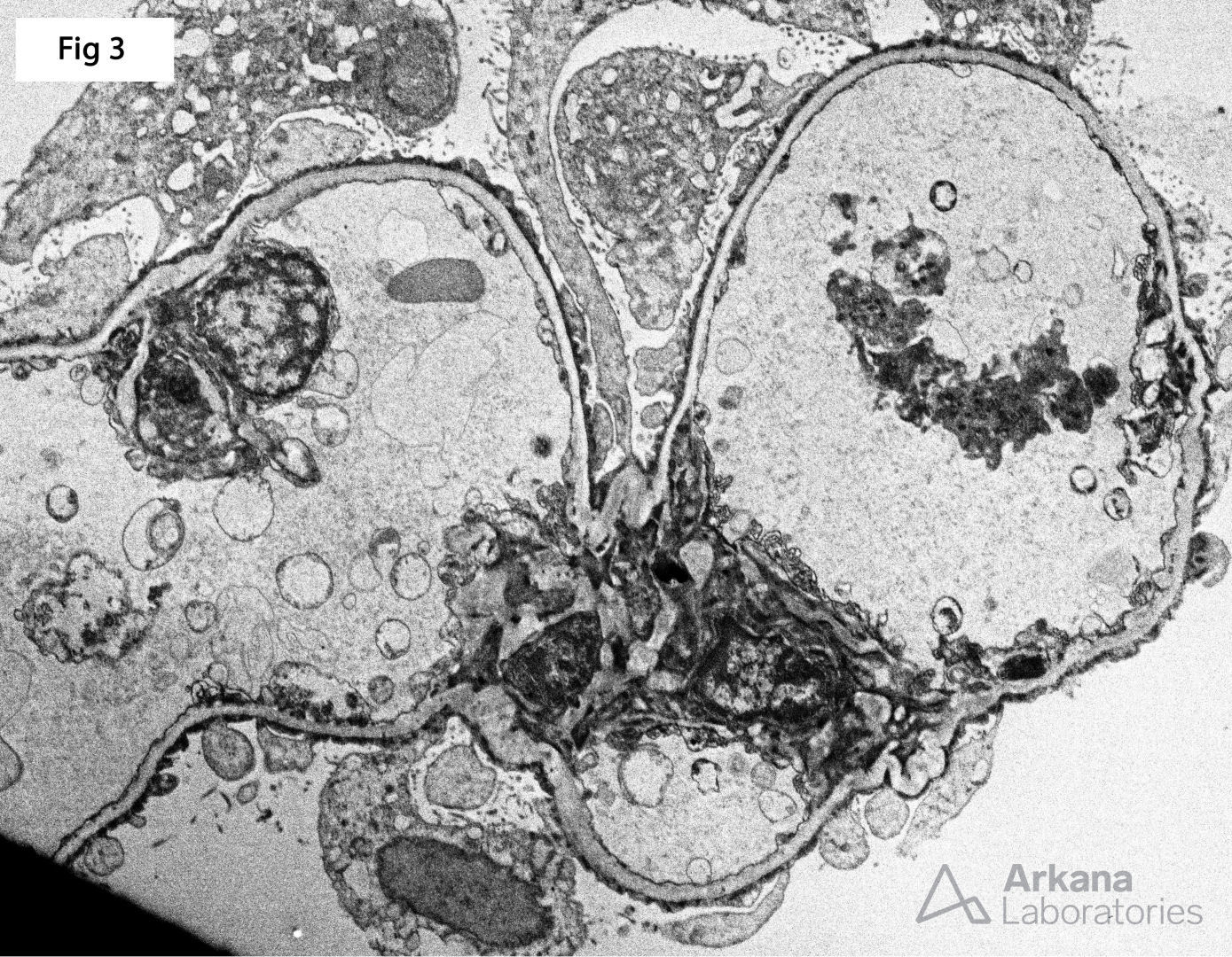 diffuse epithelial foot process effacement with microvillous transformation