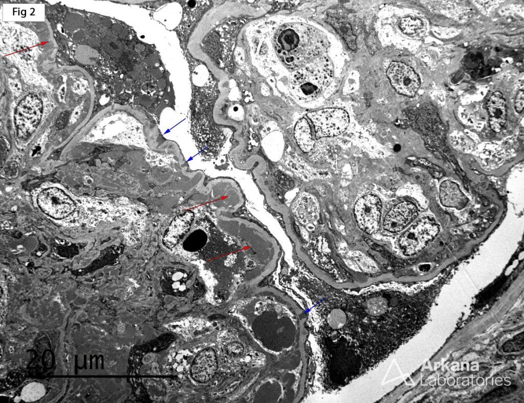 Subepithelial Deposits in Lupus Nephritis