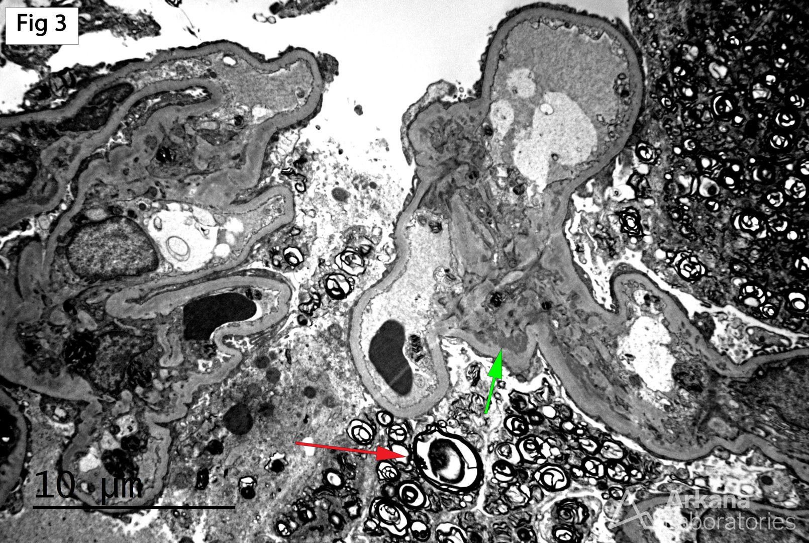 IgA nephropathy