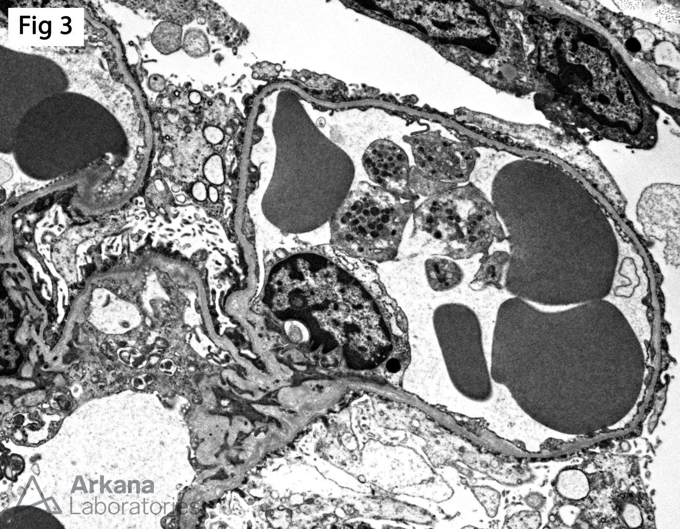 diffuse epithelial foot process effacement with microvillous transformation, Congenital Nephrotic Syndrome