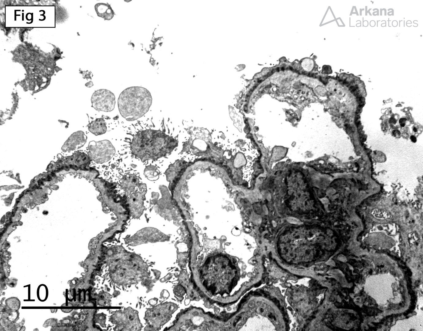 Alport Syndrome