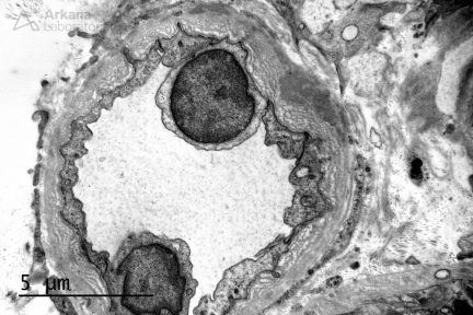 Chronic Antibody Mediated Rejection