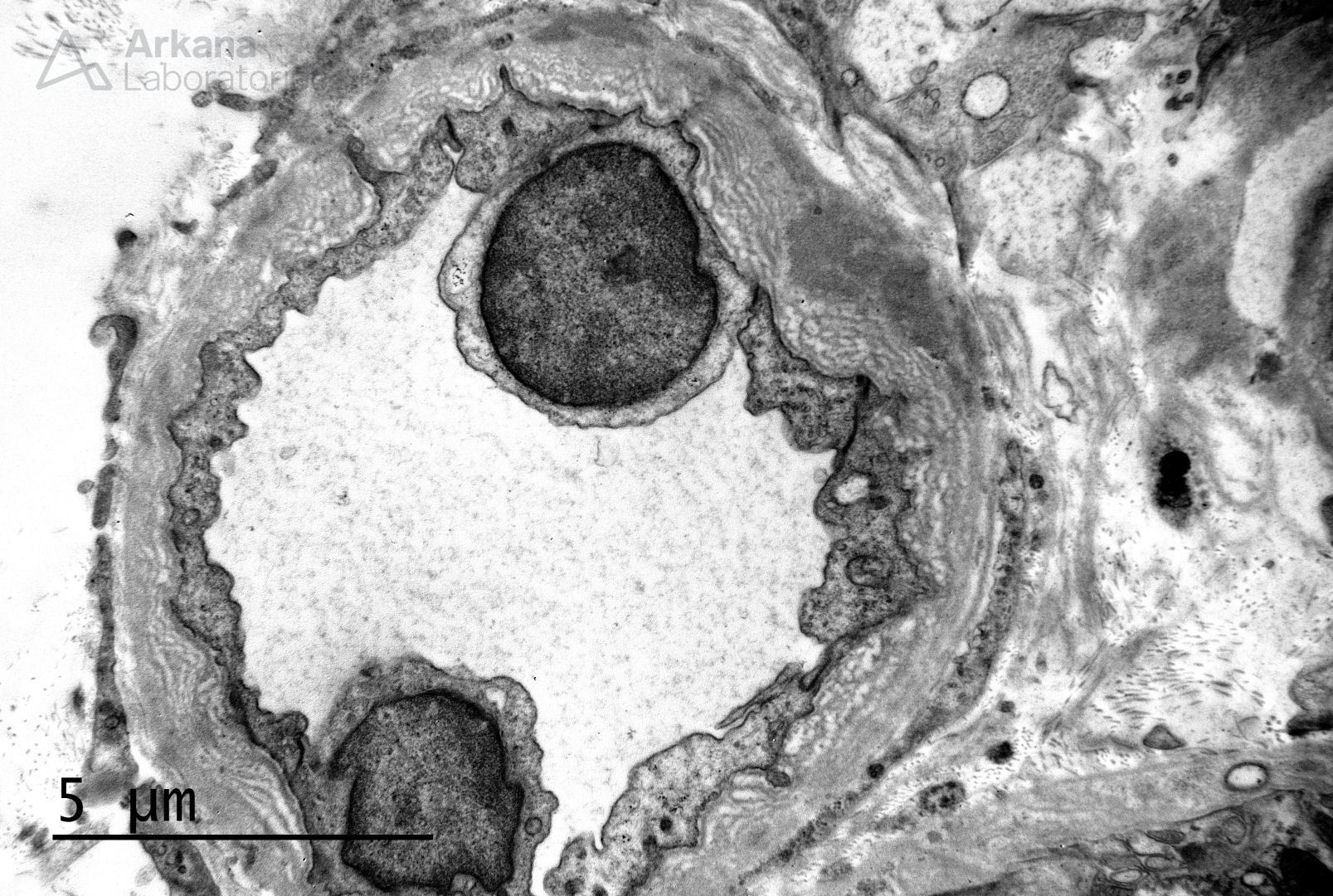 Chronic Antibody Mediated Rejection