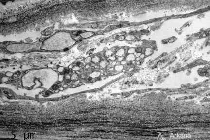 light chain deposition disease