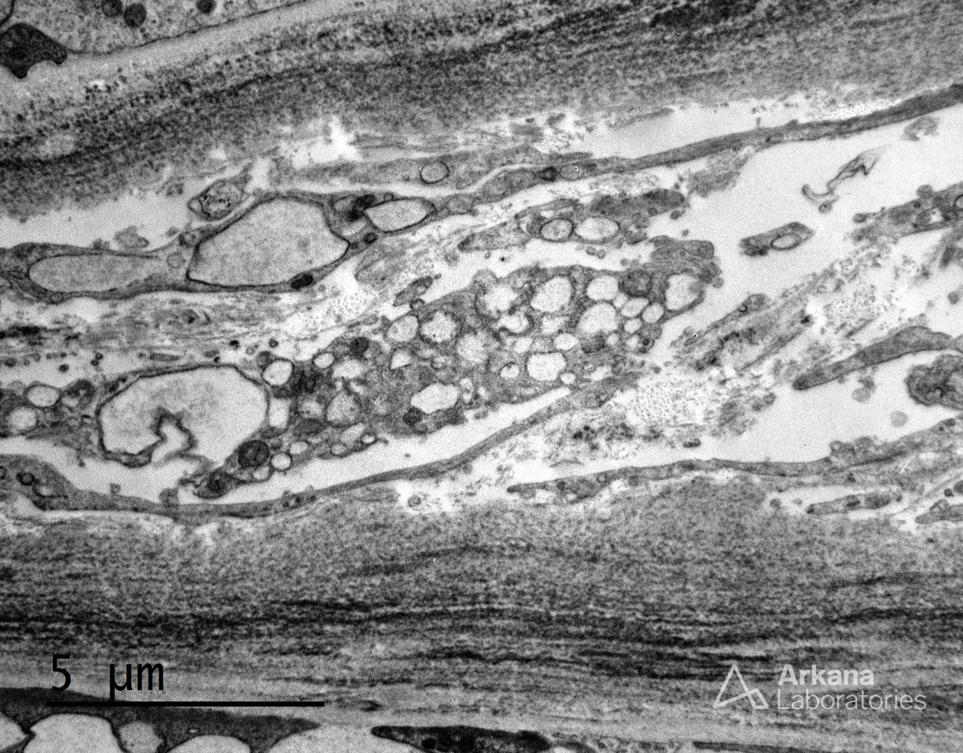 light chain deposition disease