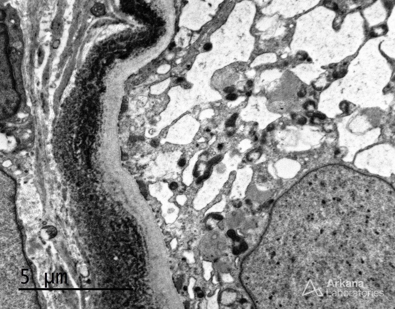 light chain deposition disease