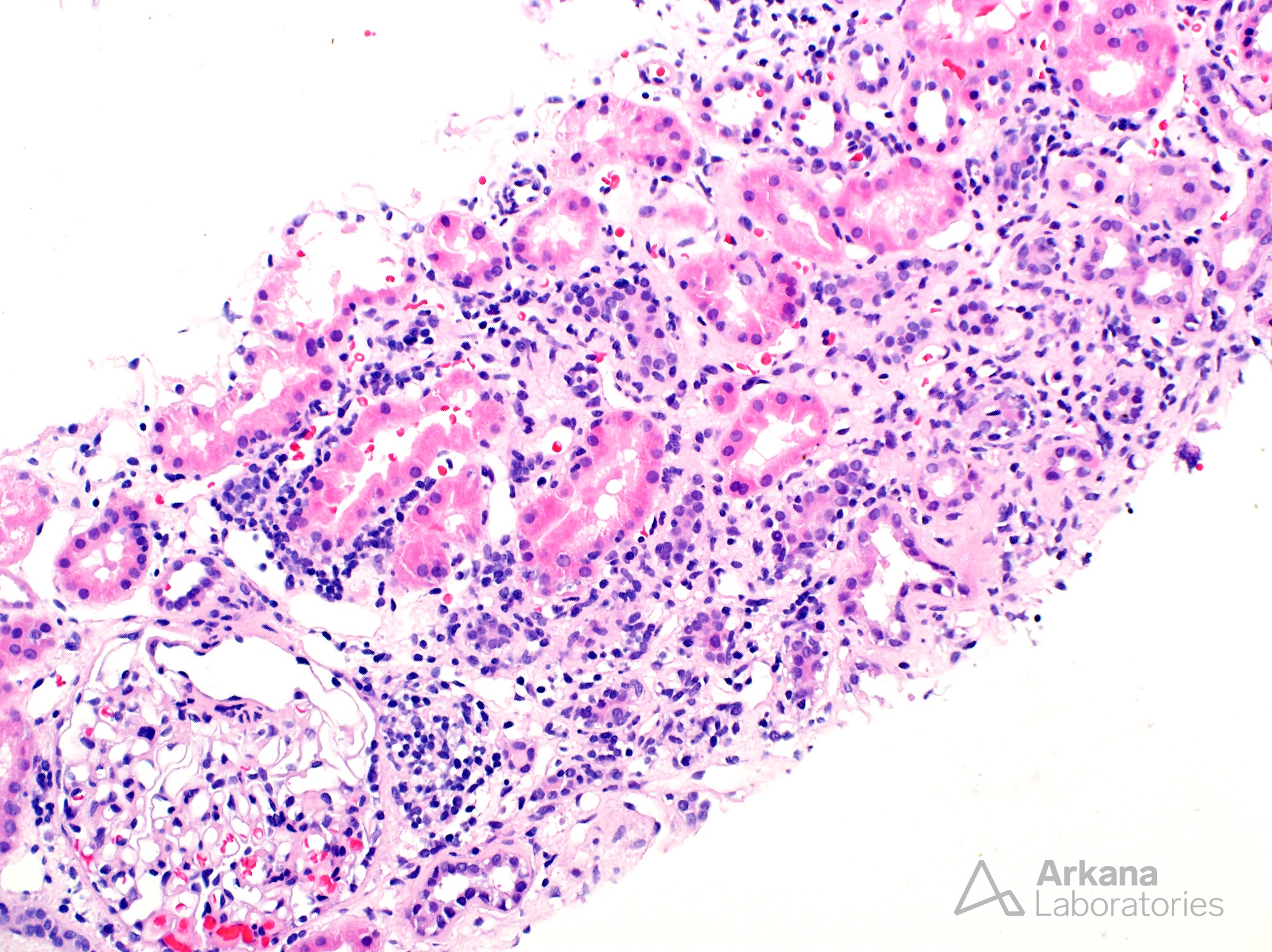 Tubulointerstitial nephritis with uveitis, TINU