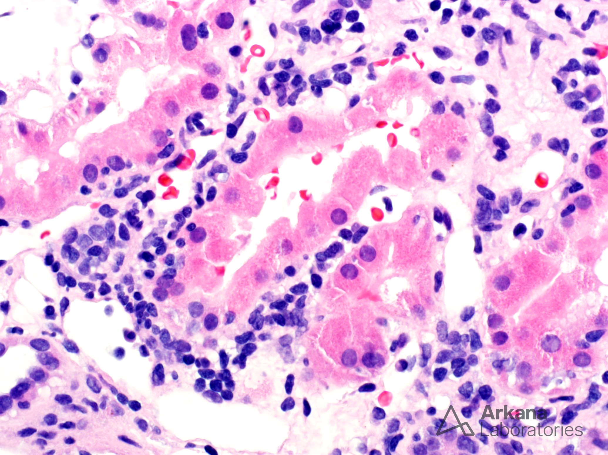 Tubulointerstitial nephritis with uveitis, TINU