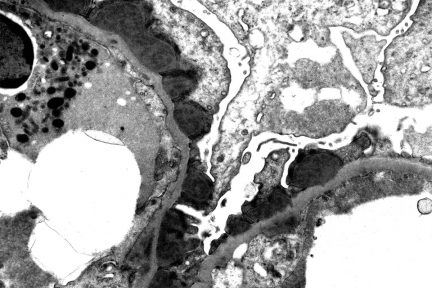 Infection-Associated Glomerulonephritis