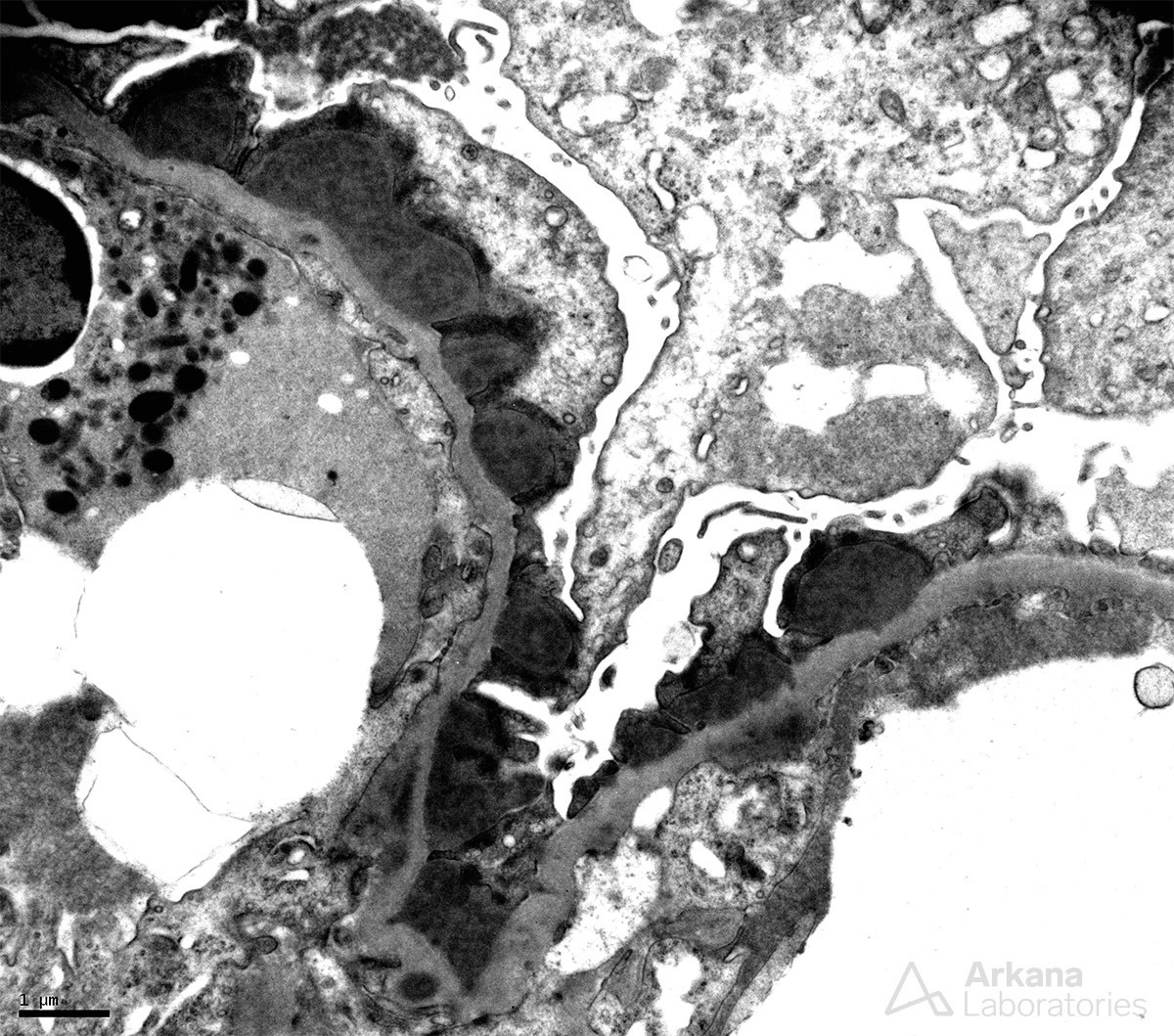 Infection-Associated Glomerulonephritis