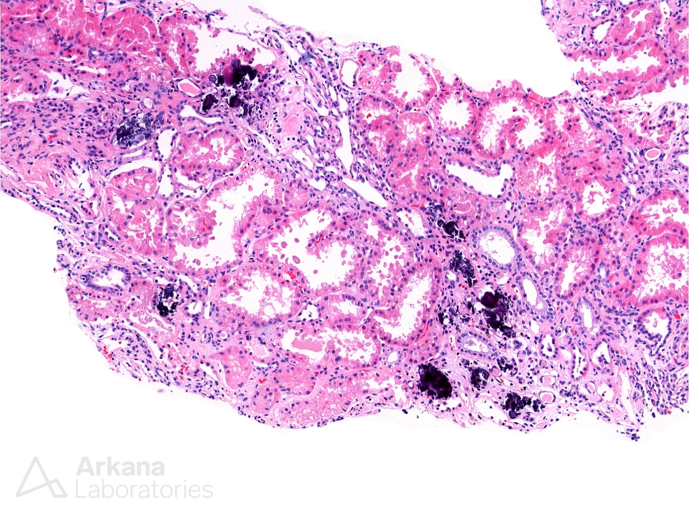 Nephrocalcinosis in Sarcoid