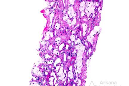 interstitium shows frequent clusters of interstitial foam cells