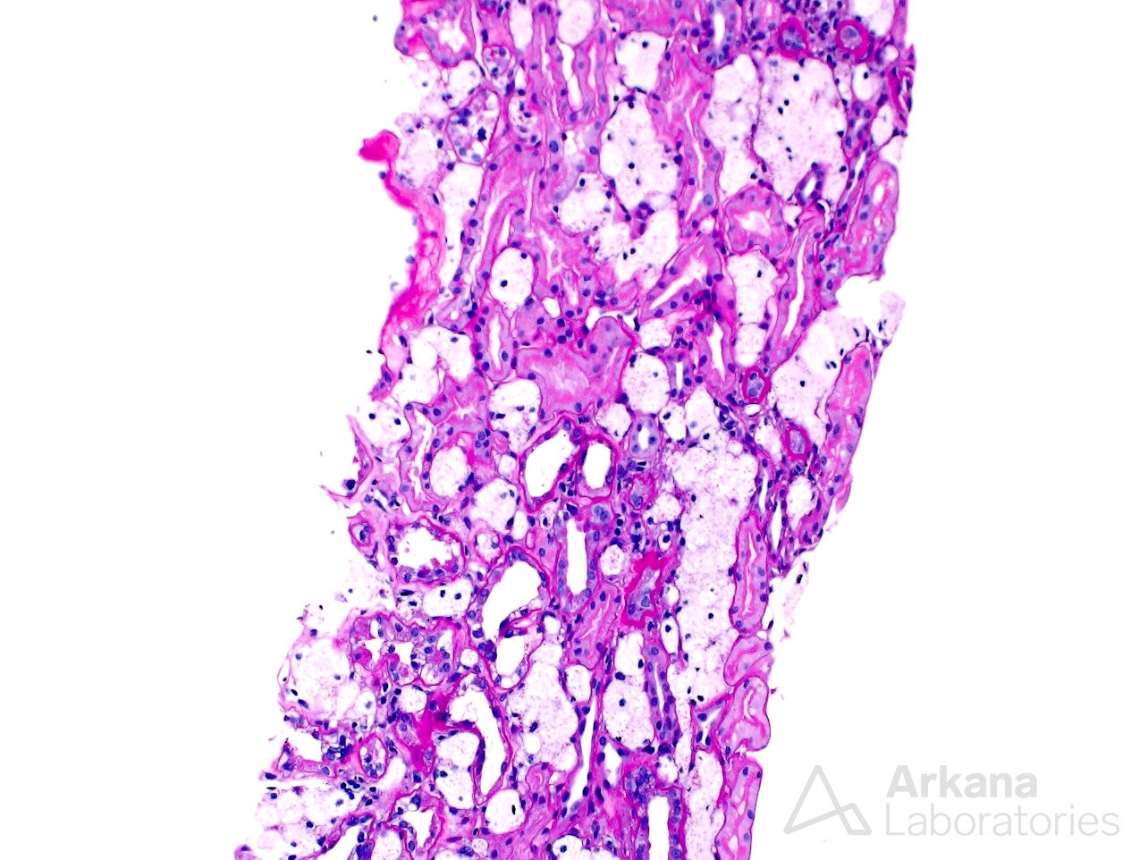 interstitium shows frequent clusters of interstitial foam cells