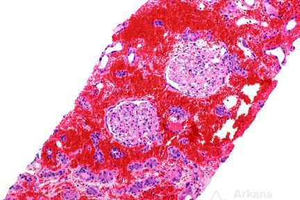 Interstitial Hemorrhage in renal cortex