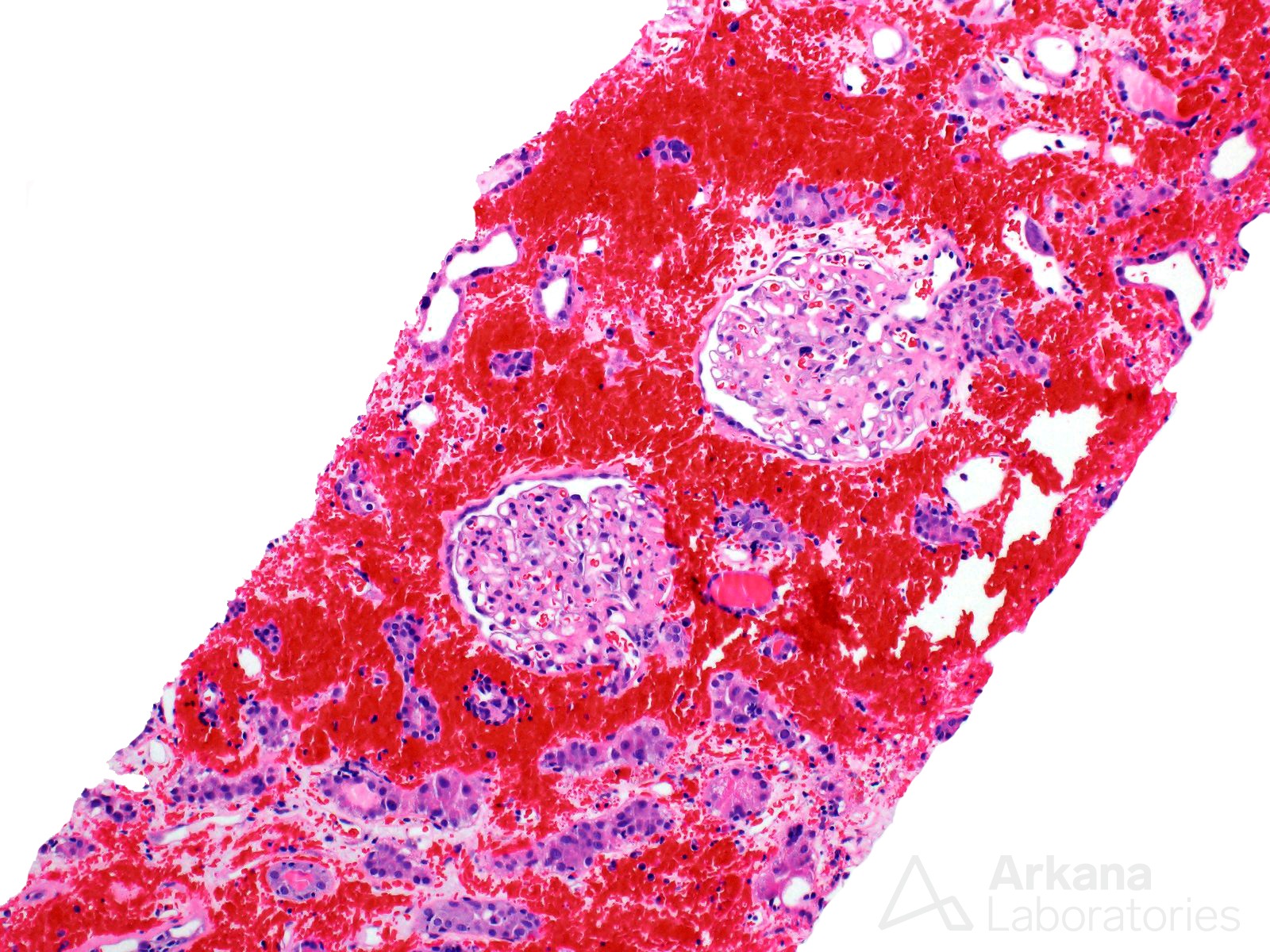 Interstitial Hemorrhage in renal cortex