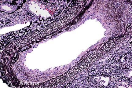 intimal arteritis