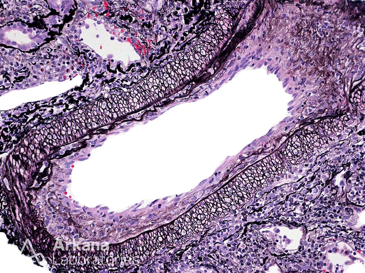 intimal arteritis