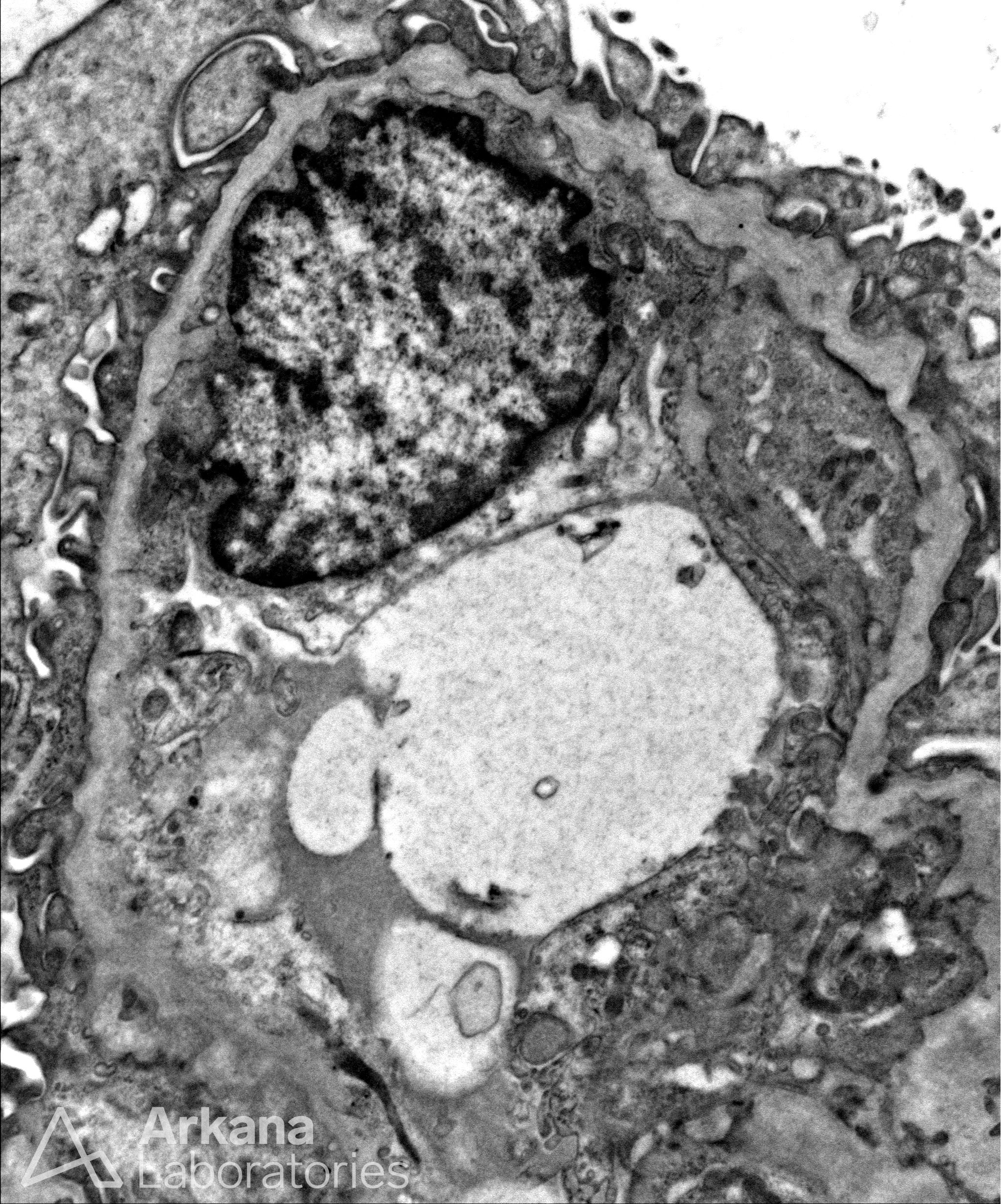 Alport Syndrome