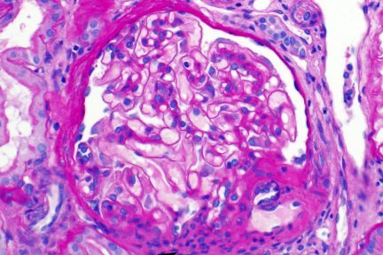 Juxtaglomerular Apparatus Hyperplasia