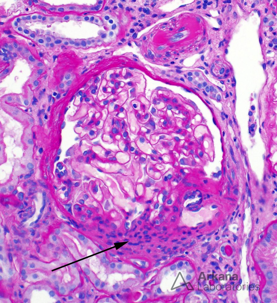 Juxtaglomerular Apparatus Hyperplasia