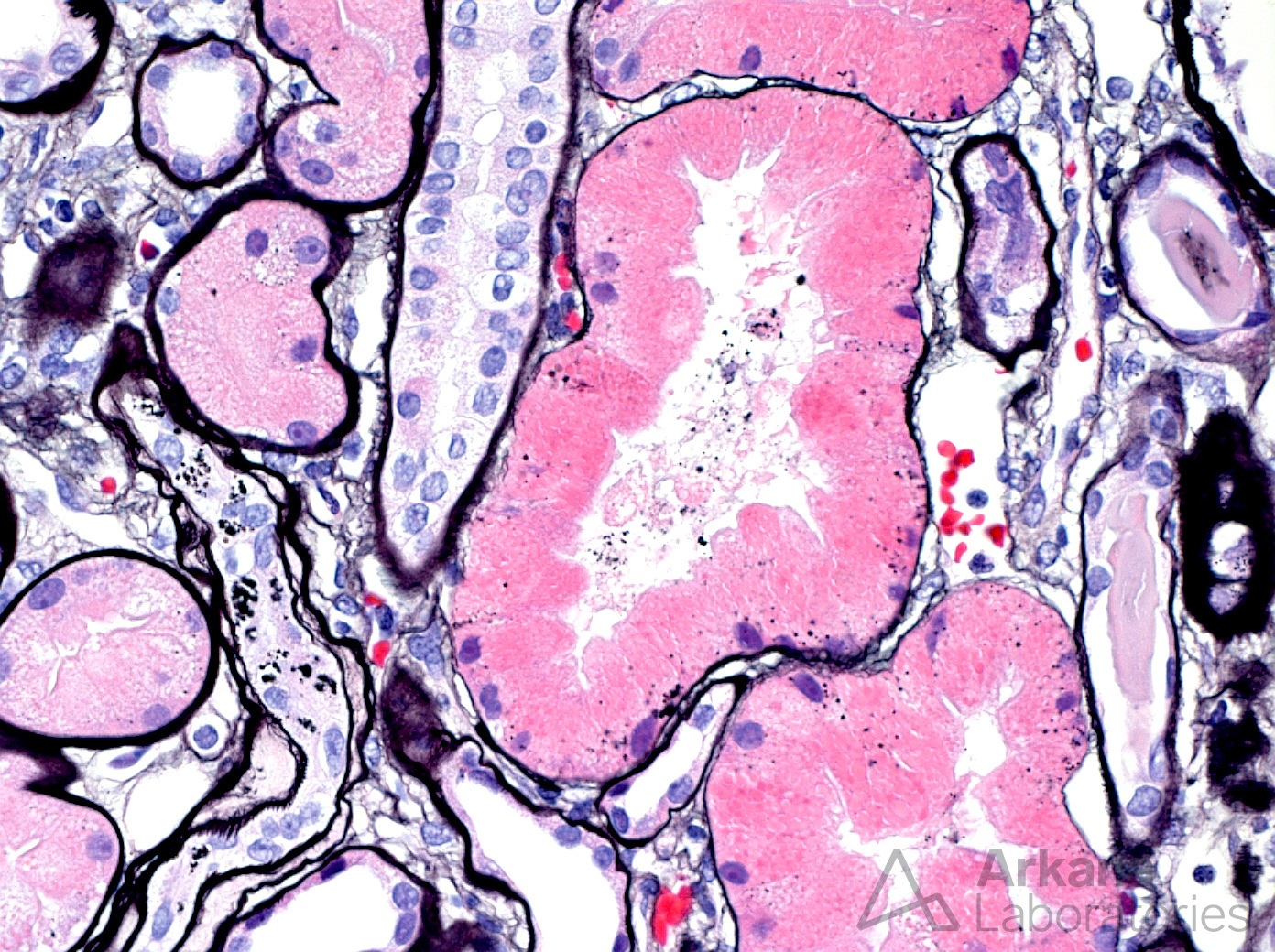 Lysozyme Nephropathy imaging