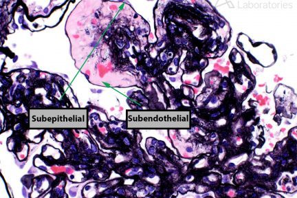 Jones stain, jones depositis, arkana laboratories, renal biopsy, kidney biopsies