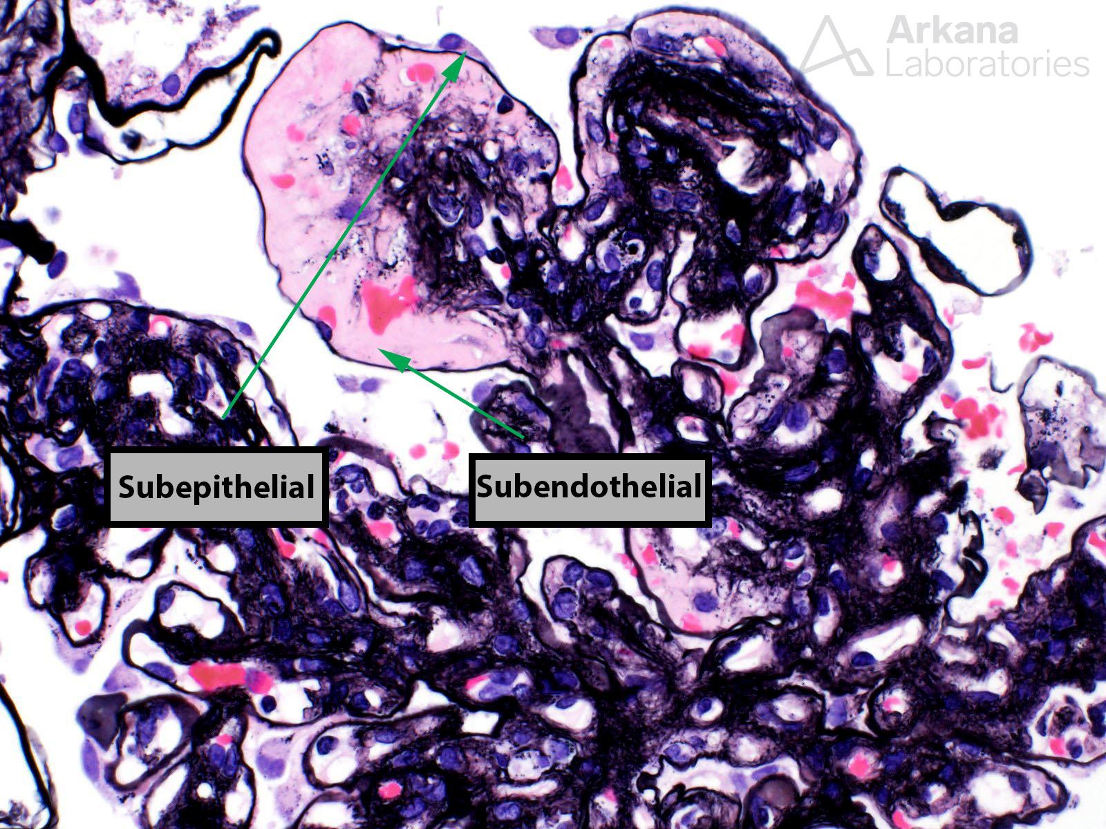 Jones stain, jones depositis, arkana laboratories, renal biopsy, kidney biopsies