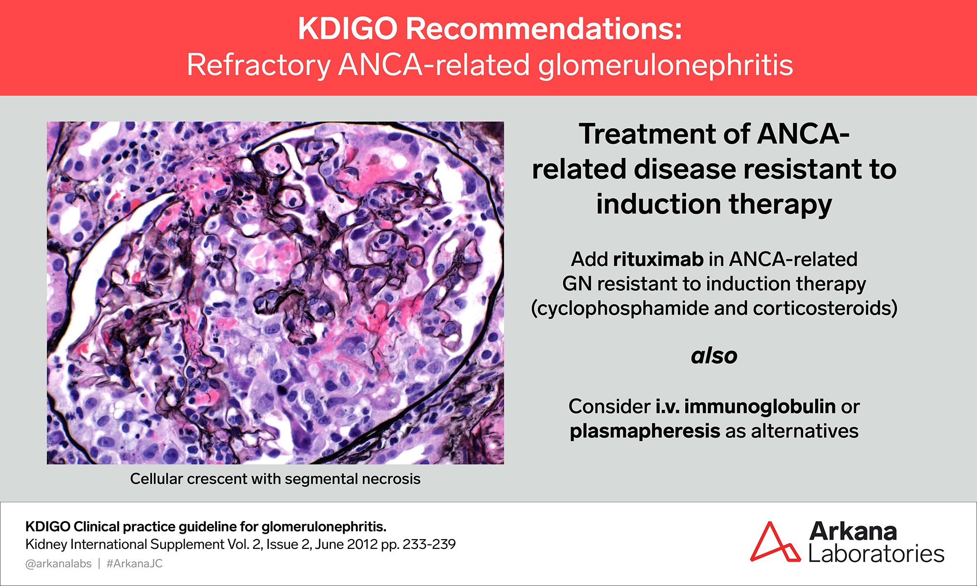 refractory ANCA-related glomerulonephritis
