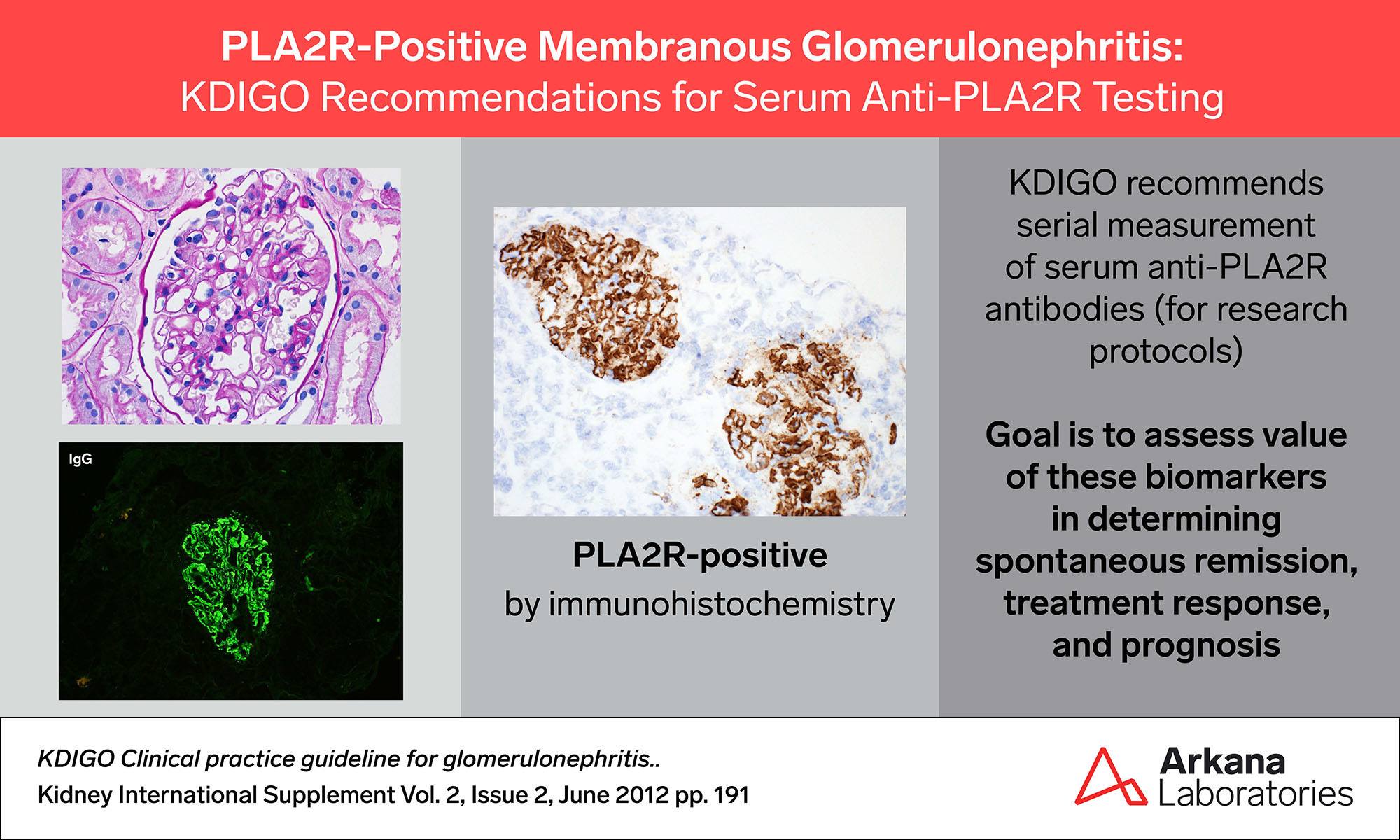 PLA2R-Positive Membranous Glomerulonephritis, PLA2R, KDIGO Connections, Arkana Laboratories