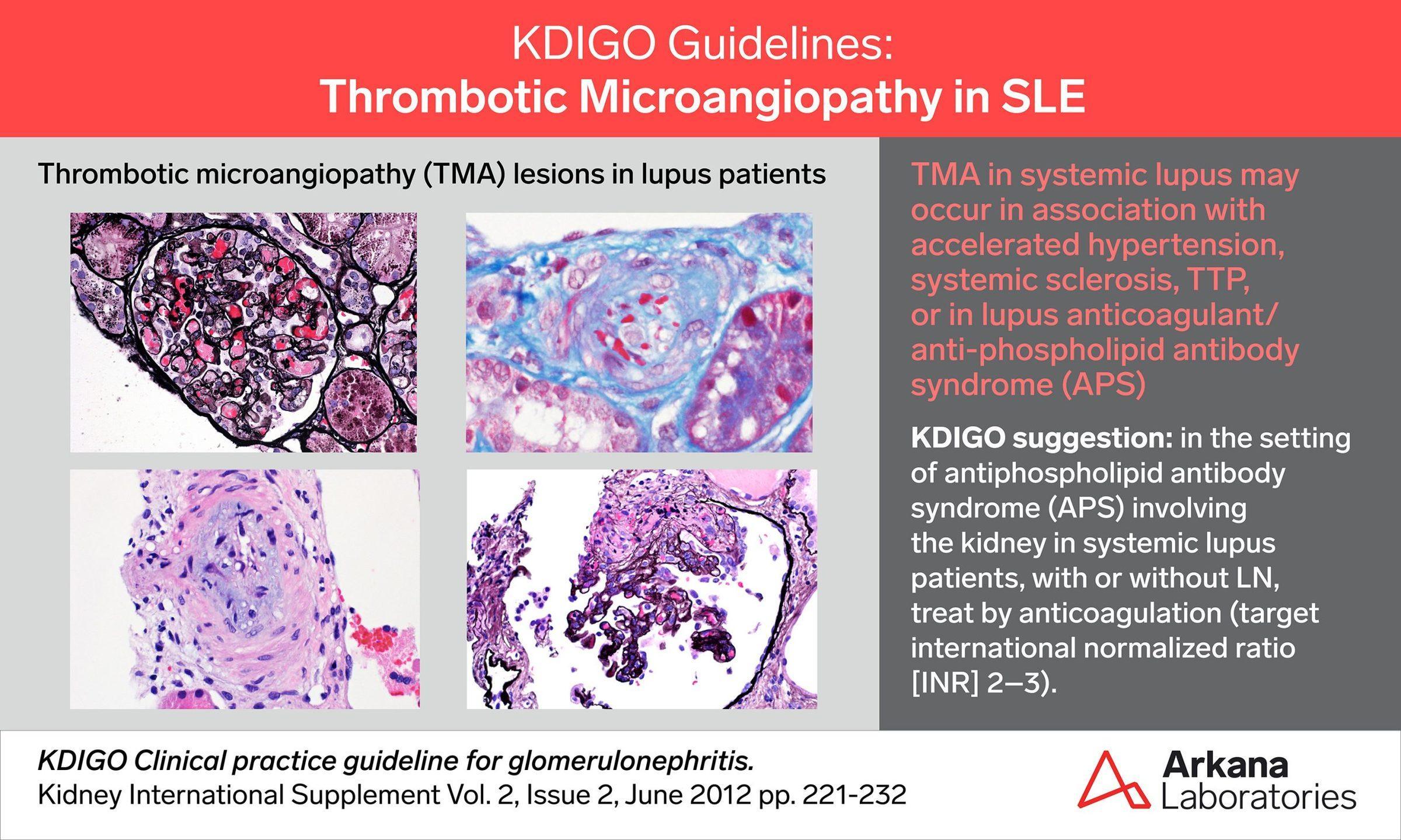 SLE and TMA, KDIGO Connections, Arkana Laboratories, pathology, renal disease