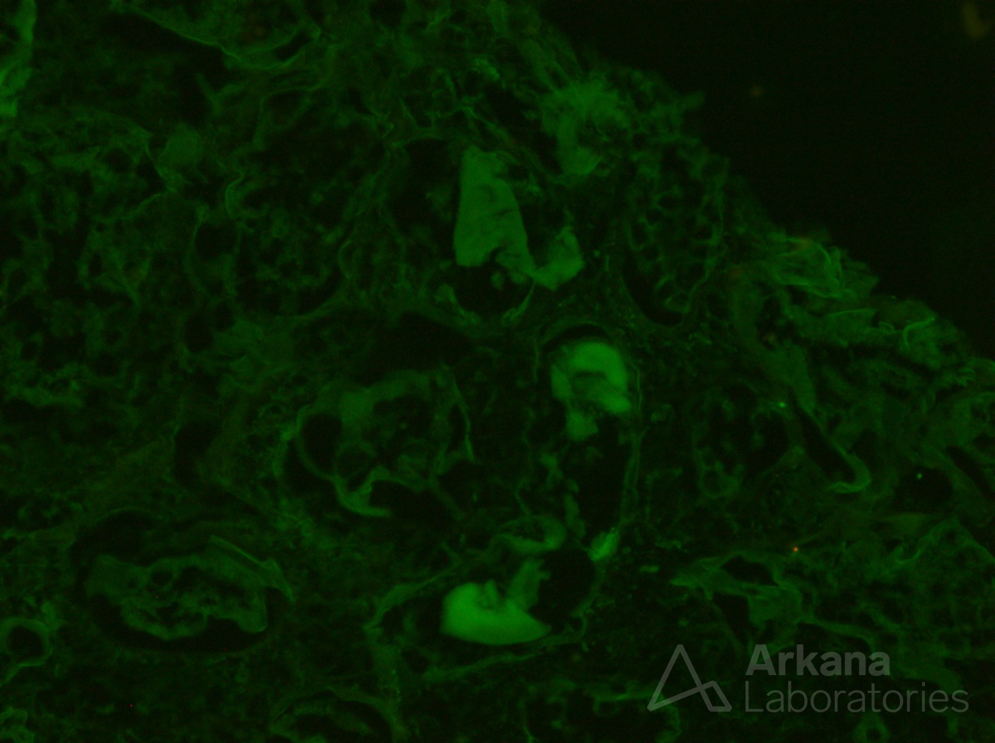 Amyloid Cast Nephropathy