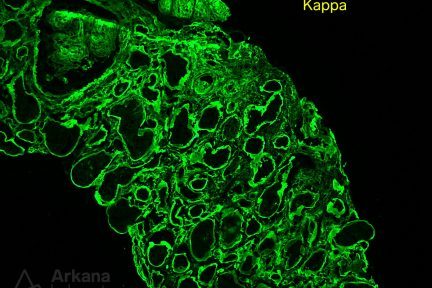 Light Chain Deposition Disease