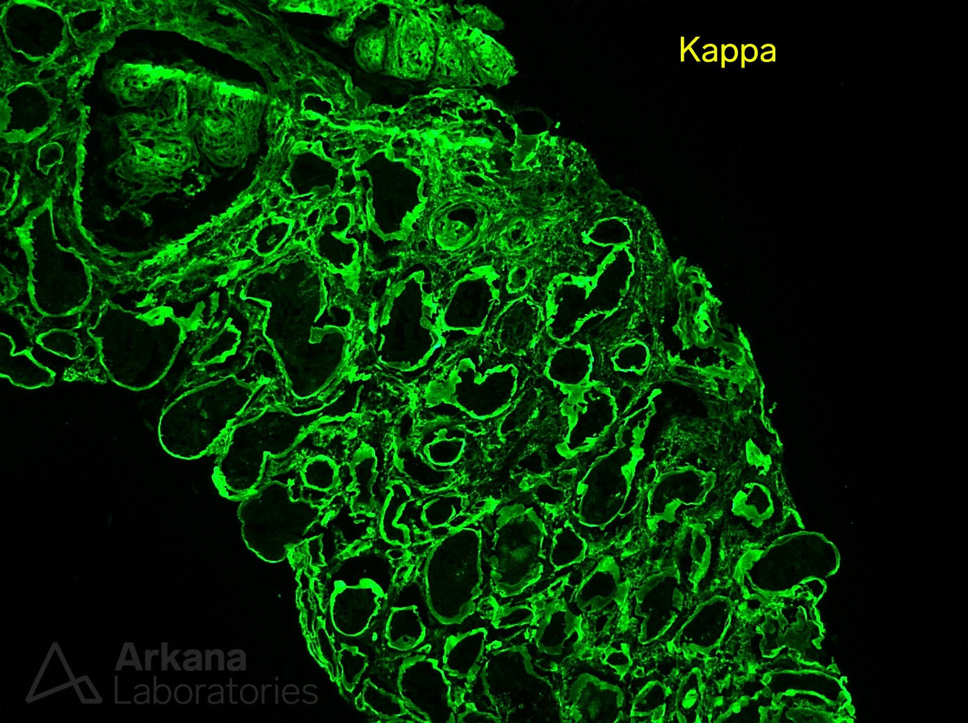 Light Chain Deposition Disease