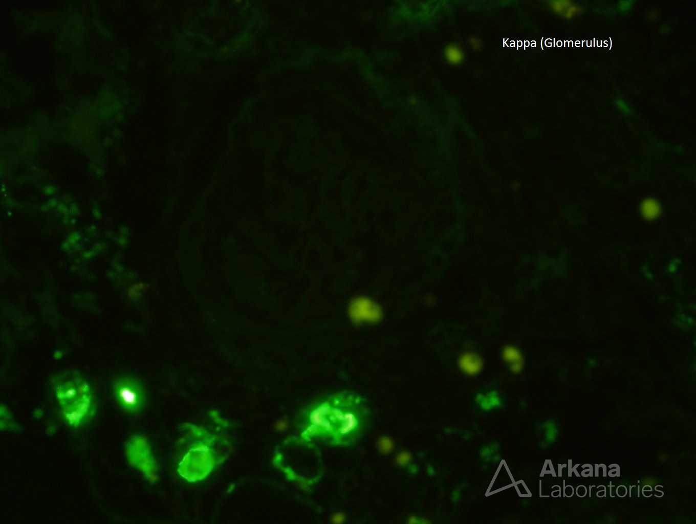 IF Kappa stain of renal biopsy