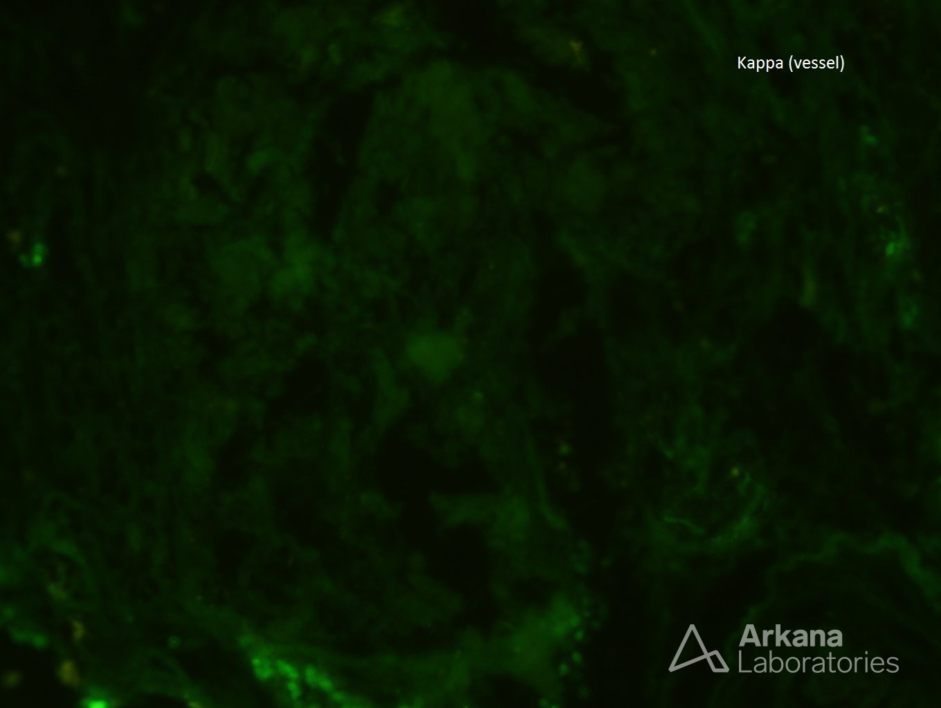 Kappa stain of renal biopsy