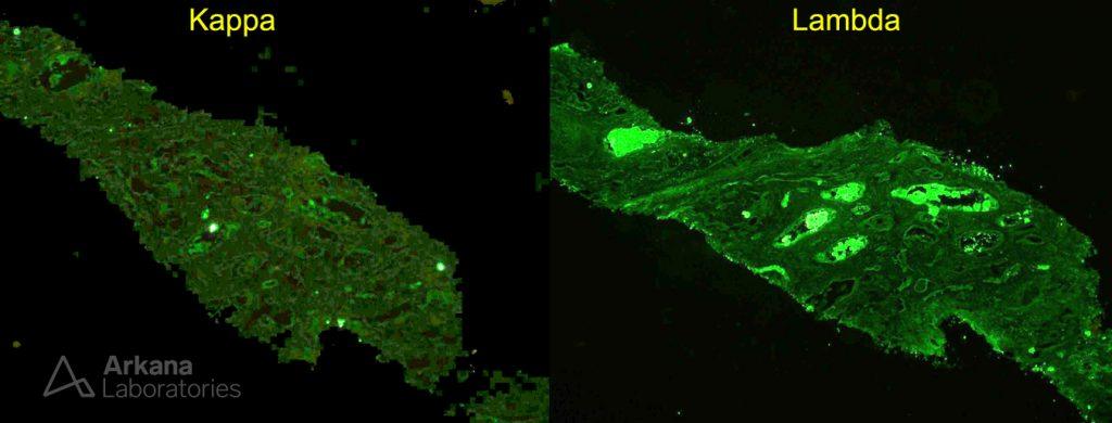 lambda light chain cast nephropathy