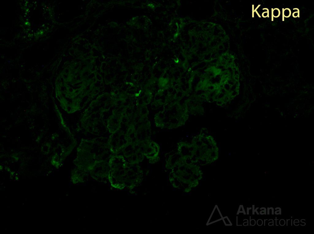 Kappa stain, Monoclonal Gammopathy of Renal Significance